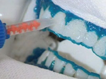 3008bca45125218b16efd39e52f0c9ca.png 牙本质保护剂.png